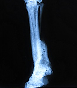 Missy's healed fracture 1