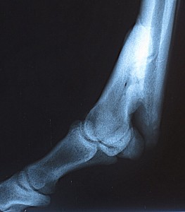 Missy's healed fracture 2